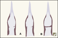 Types de jugulaires sur des plongeons en plumage internuptial et juvénile